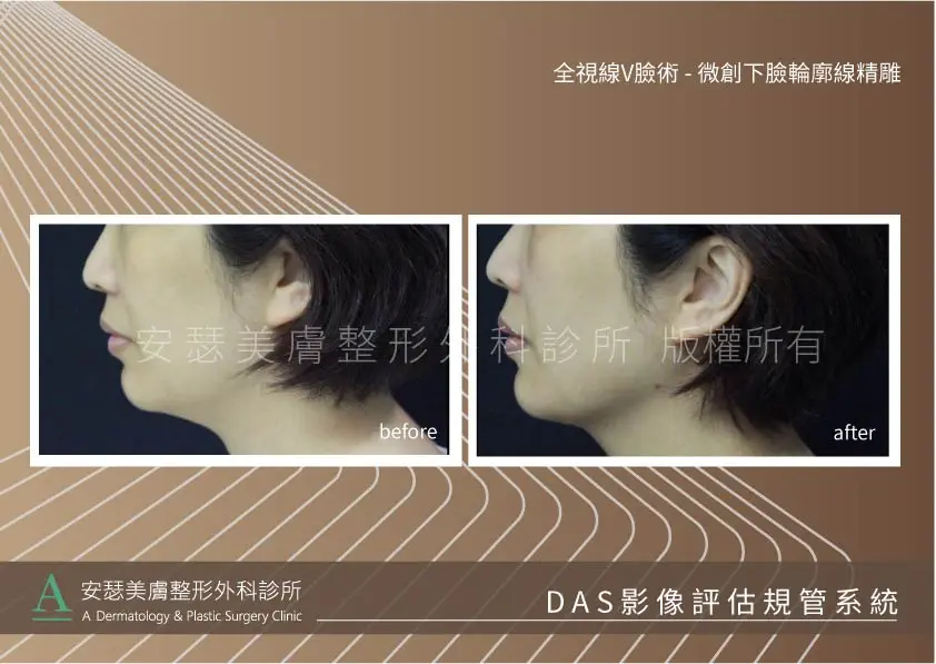 下巴輪廓線案例-04r