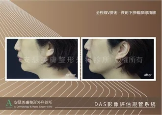 下巴輪廓線案例-04r