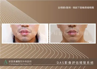 下巴輪廓線案例-01r