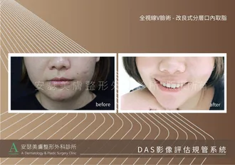 改良式分層口內取脂案例-01